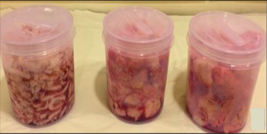 Morcellated pieces of myoma